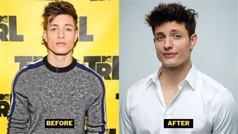 matt rife before and after plastic surgery|Matt Rife denies plastic surgery, explains why face changed